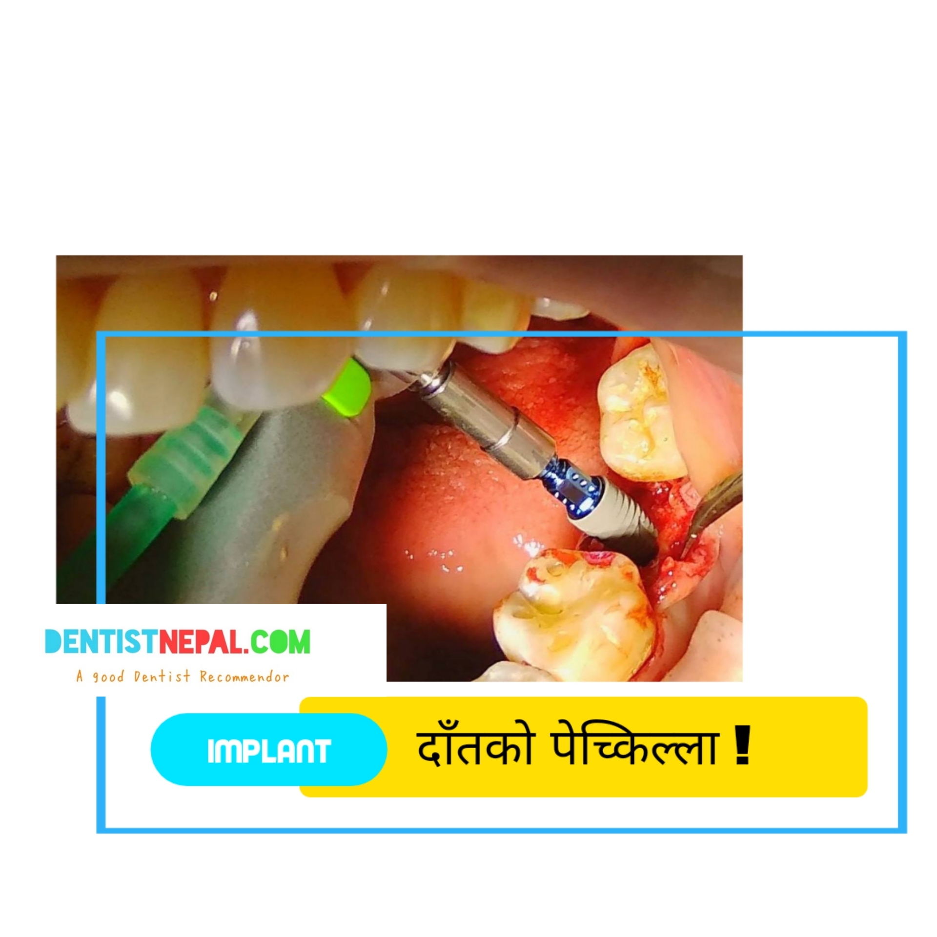 Implant Dentist trend in Nepal. Next to natural type teeth.